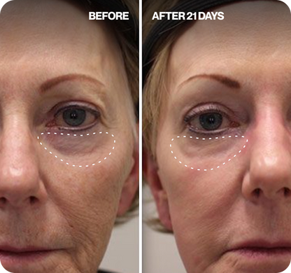 Renewa Eyelift